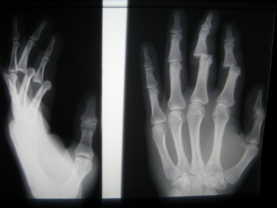 Tom's 1st Whistler XRAY; ouch.jpg